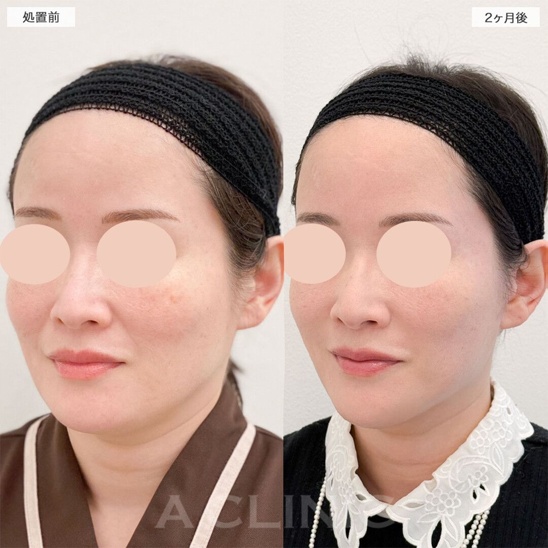 A式美肌たるみ切開でたるみを根本的に解決！こちら処置前と2ヶ月後の症例です(40代女性)
