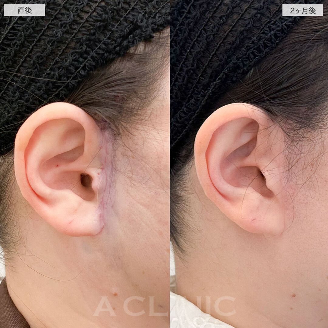 A式美肌たるみ切開でたるみを根本的に解決！こちら処置前と2ヶ月後の症例です(40代女性)