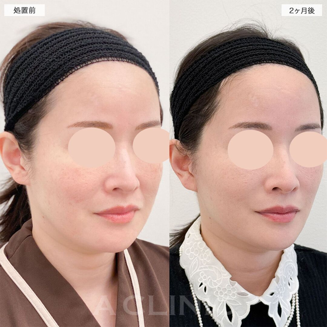 A式美肌たるみ切開でたるみを根本的に解決！こちら処置前と2ヶ月後の症例です(40代女性)