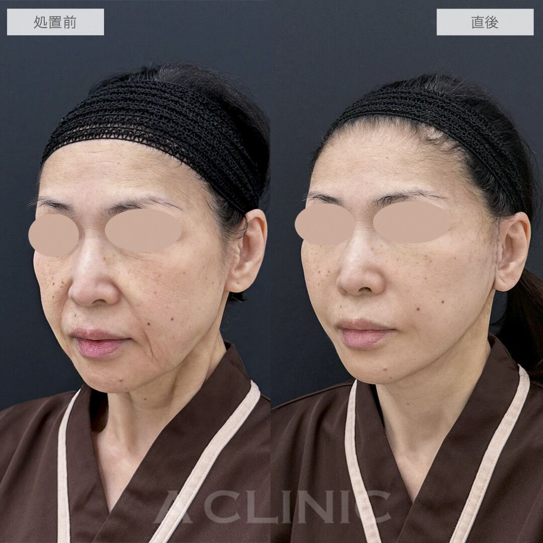 抜糸不要のフェイスリフトだから最小限のダウンタイムで若返り可能です！A式美肌たるみ切開の処置前と直後の症例です(60代女性)