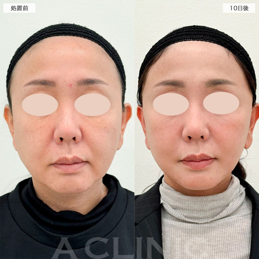 【直後の傷跡あり】ダウンタイムを最小限に抑えたフェイスリフト！A式美肌たるみ切開の処置前から10日後の症例です(40代女性)