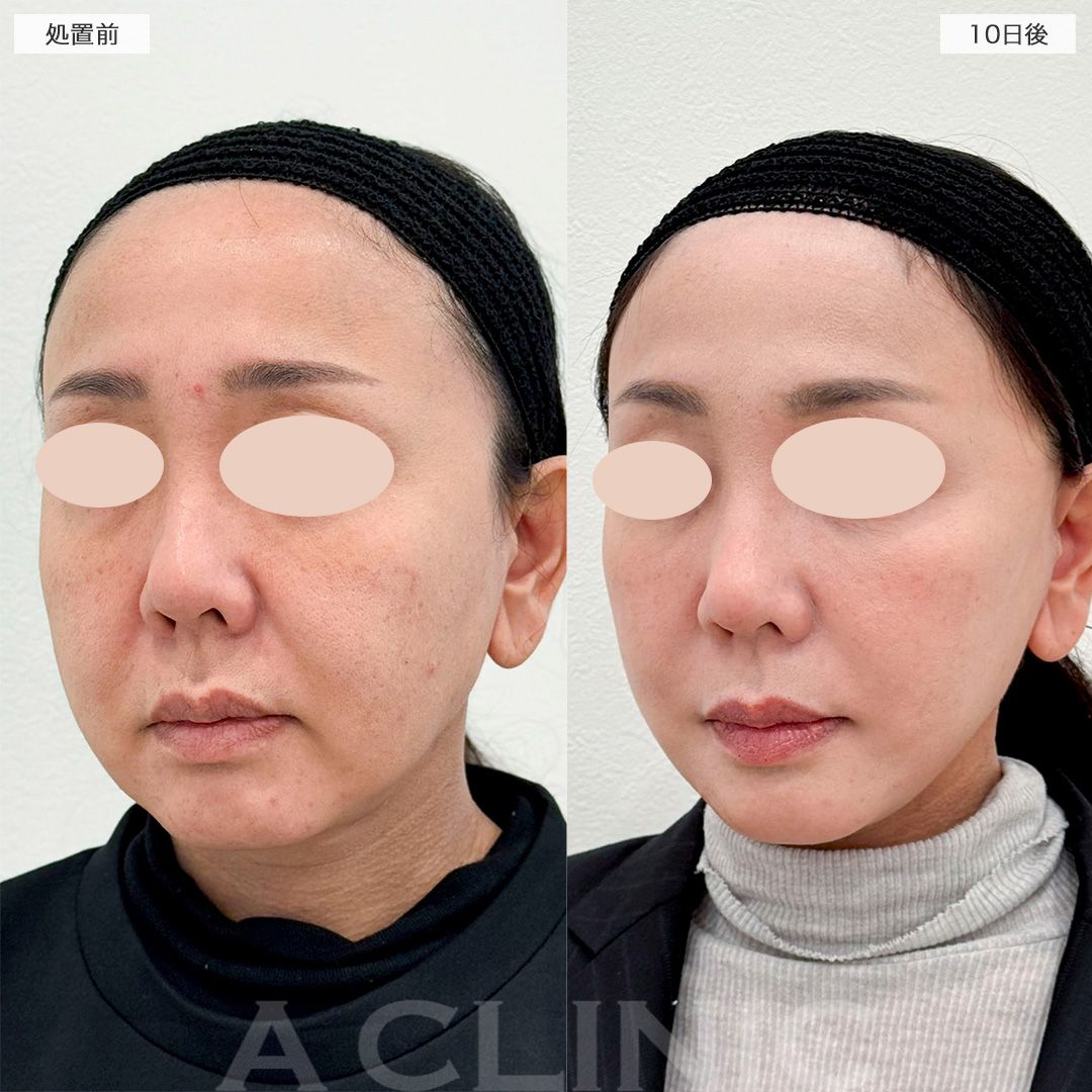 【直後の傷跡あり】ダウンタイムを最小限に抑えたフェイスリフト！A式美肌たるみ切開の処置前から10日後の症例です(40代女性)