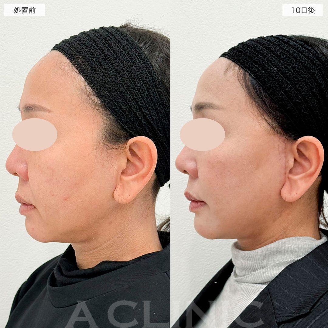 【直後の傷跡あり】ダウンタイムを最小限に抑えたフェイスリフト！A式美肌たるみ切開の処置前から10日後の症例です(40代女性)