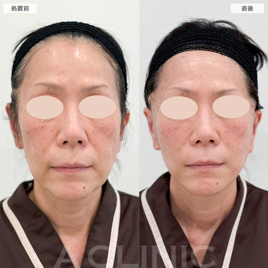 【直後の傷跡あり】直後からフェイスラインの変化を実感！A式美肌たるみ切開の処置前と直後の症例です(60代女性)