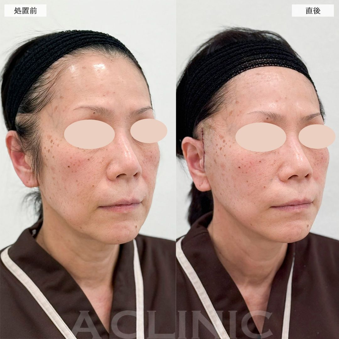 【直後の傷跡あり】直後からフェイスラインの変化を実感！A式美肌たるみ切開の処置前と直後の症例です(60代女性)