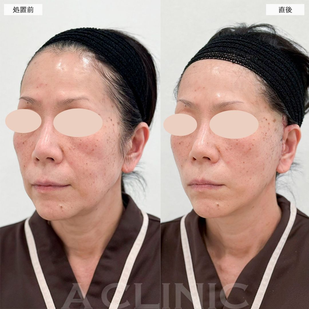 【直後の傷跡あり】直後からフェイスラインの変化を実感！A式美肌たるみ切開の処置前と直後の症例です(60代女性)