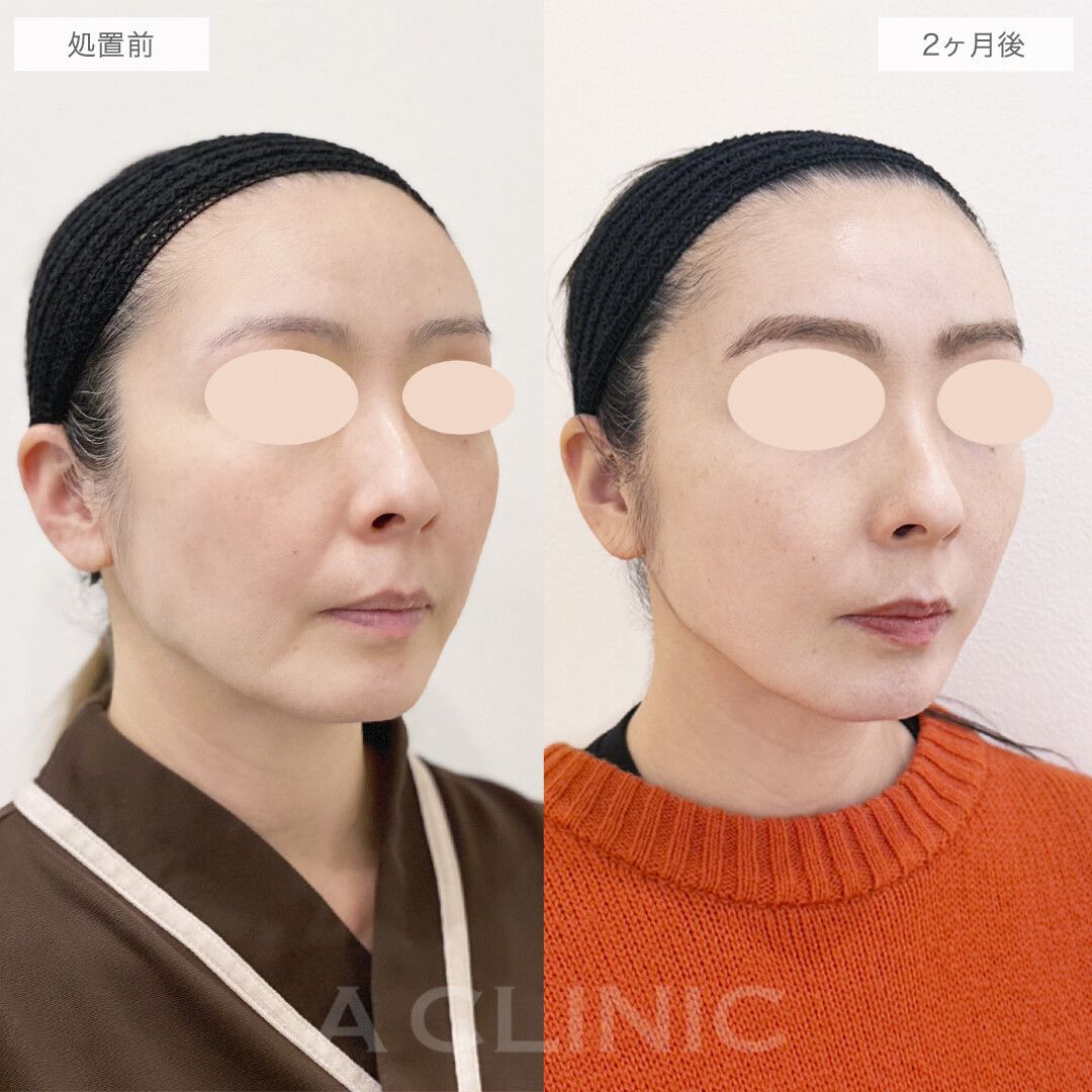口横のもたつきとほうれい線が改善！A式美肌たるみ切開の処置前と2ヶ月後の症例です(40代女性)