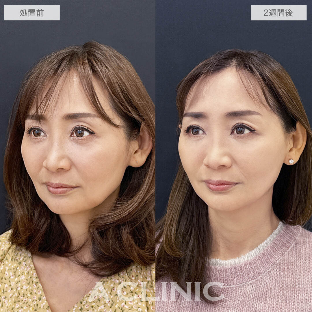 【直後の傷跡あり】ほうれい線や口元のもたつきを根本解決！A式美肌たるみ切開の処置前と2週間後の症例です(50代女性)