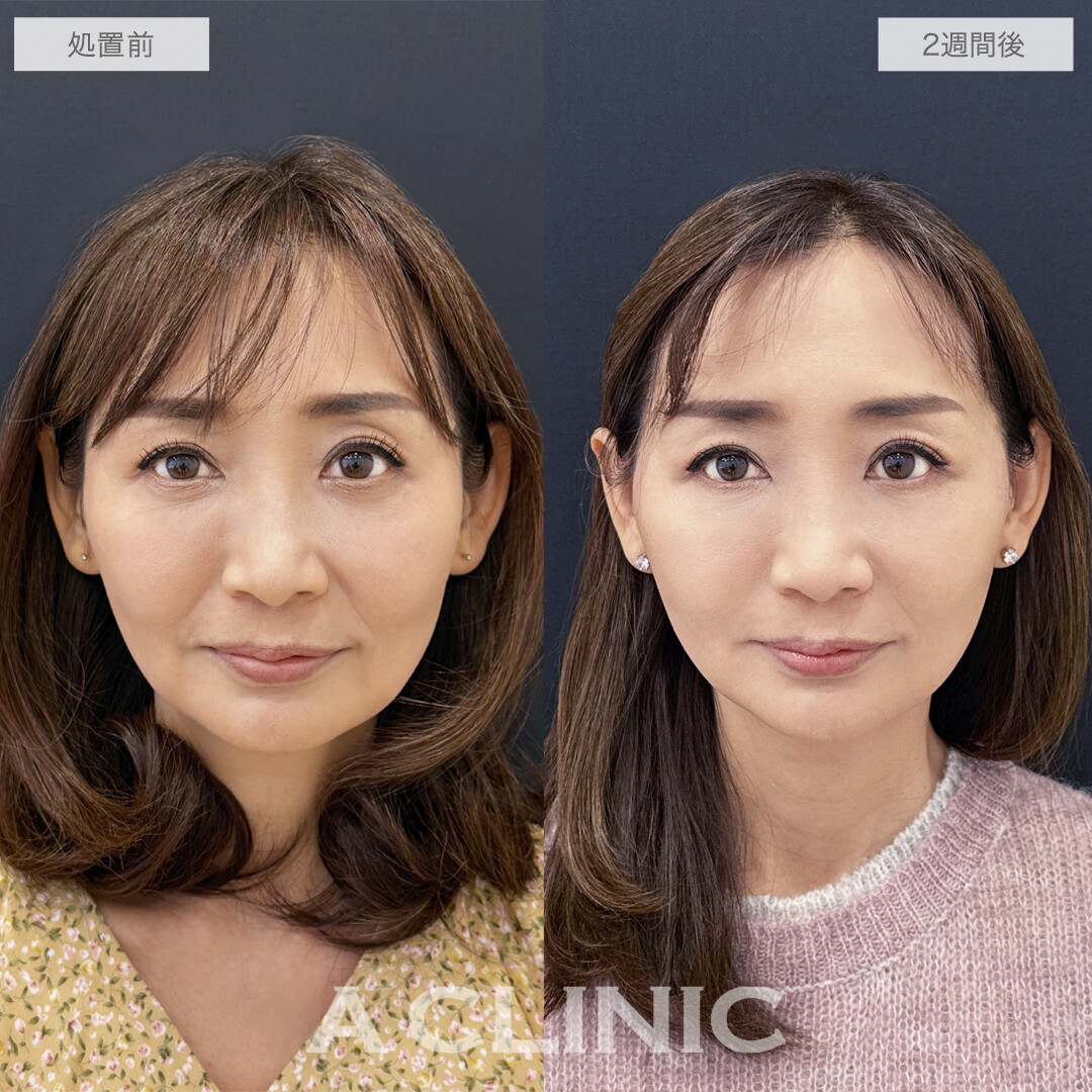 【直後の傷跡あり】ほうれい線や口元のもたつきを根本解決！A式美肌たるみ切開の処置前と2週間後の症例です(50代女性)