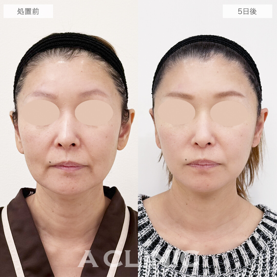 ダウンタイム最小限の切開リフトで若返り成功！A式美肌たるみ切開の処置前と5日後の症例です(50代女性)