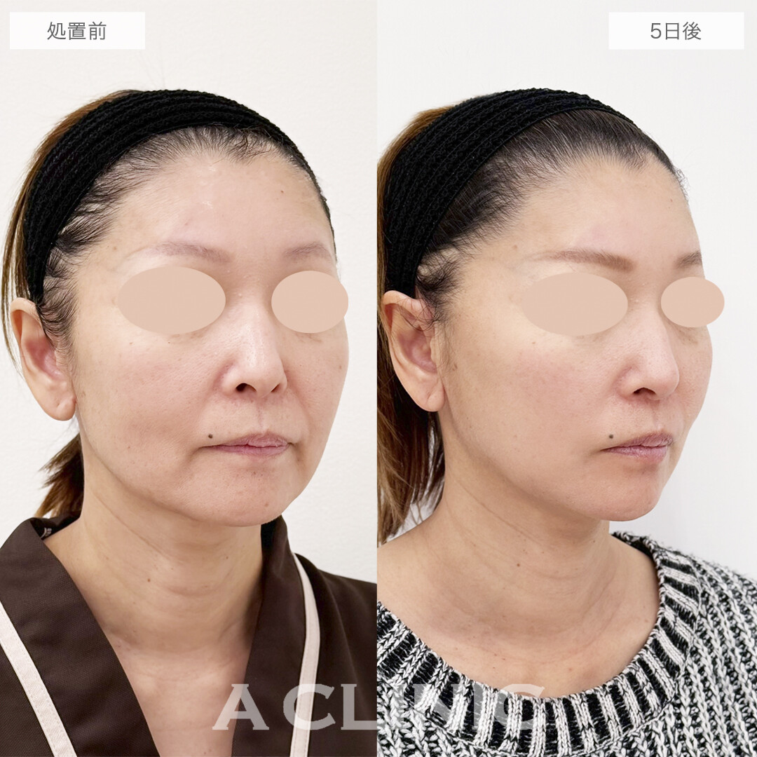 ダウンタイム最小限の切開リフトで若返り成功！A式美肌たるみ切開の処置前と5日後の症例です(50代女性)