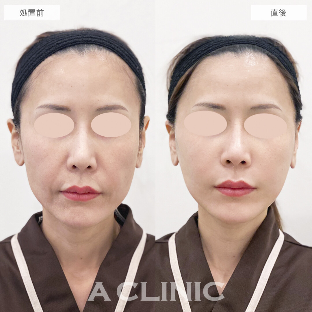 直後から別人級の若返り！A式美肌たるみ切開の処置前と直後の症例です(30代女性)