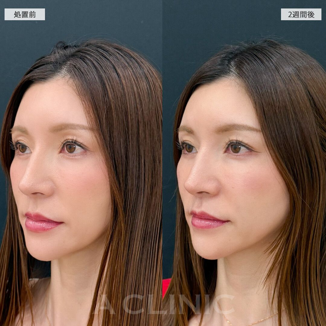 人中が短くなることでお顔全体のバランスが整いました！切らない人中短縮の処置前と2週間後の症例です(30代女性)
