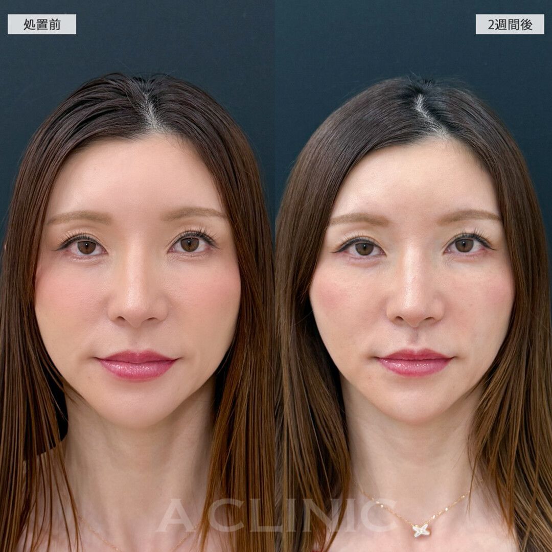 人中が短くなることでお顔全体のバランスが整いました！切らない人中短縮の処置前と2週間後の症例です(30代女性)