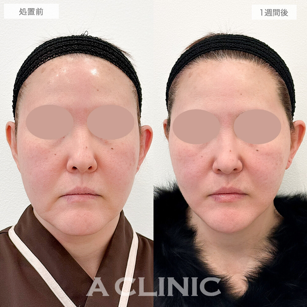 フェイスラインが引き上がり小顔効果も！A式美肌たるみ切開の処置前と1週間後の症例です(50代女性)