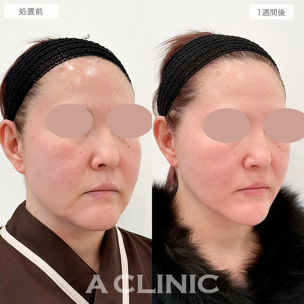 フェイスラインが引き上がり小顔効果も！A式美肌たるみ切開の処置前と1週間後の症例です(50代女性)
