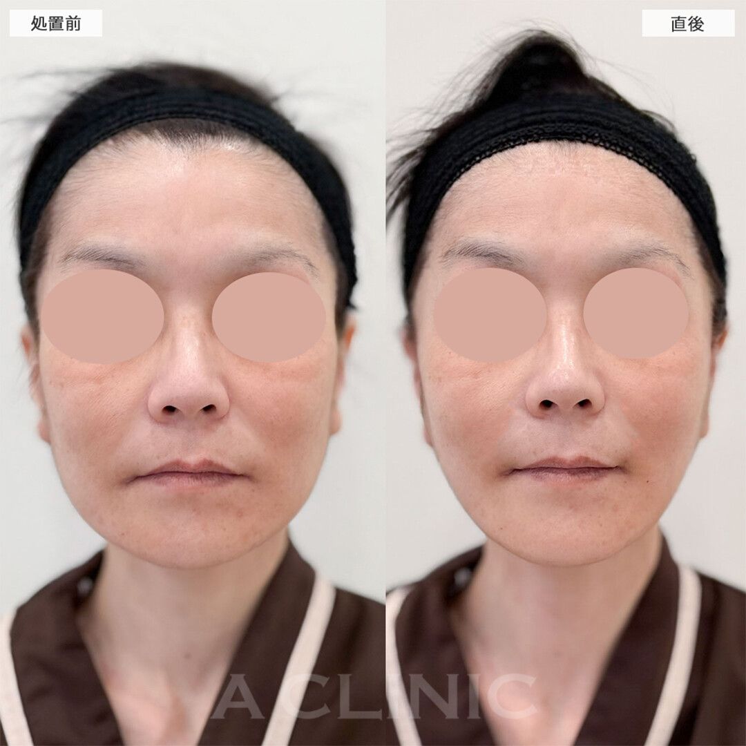 A式美肌たるみ切開は傷跡もほとんど目立たずしっかりリフトアップ！こちら処置前から3週間後の症例です(40代女性)