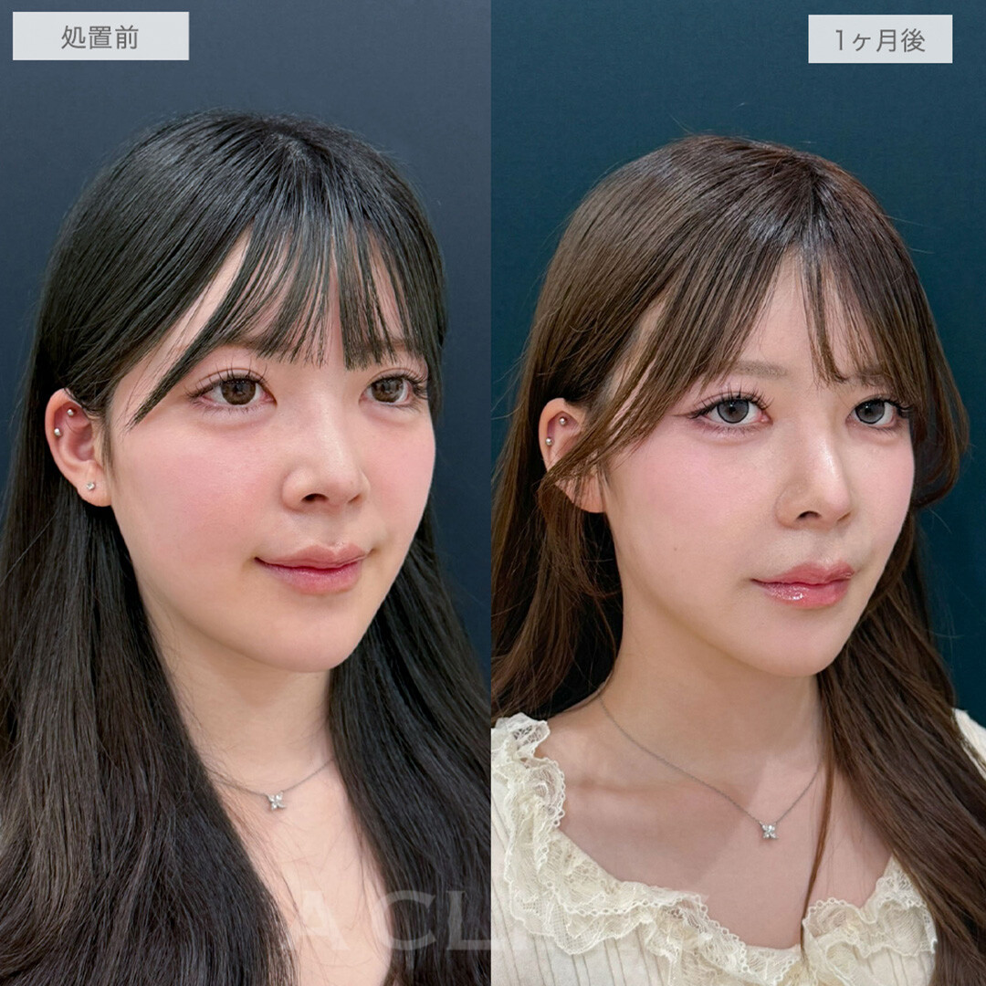 頑固な顔の脂肪とおさらば！1day小顔脂肪吸引、エラと耳下腺と額下のボトックス注射の処置前と1ヶ月後の症例です(20代女性)