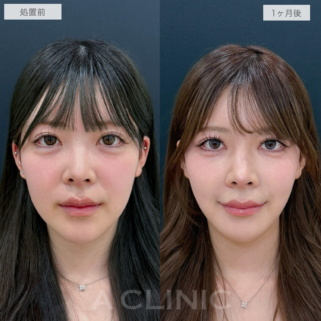 頑固な顔の脂肪とおさらば！1day小顔脂肪吸引、エラと耳下腺と額下のボトックス注射の処置前と1ヶ月後の症例です(20代女性)