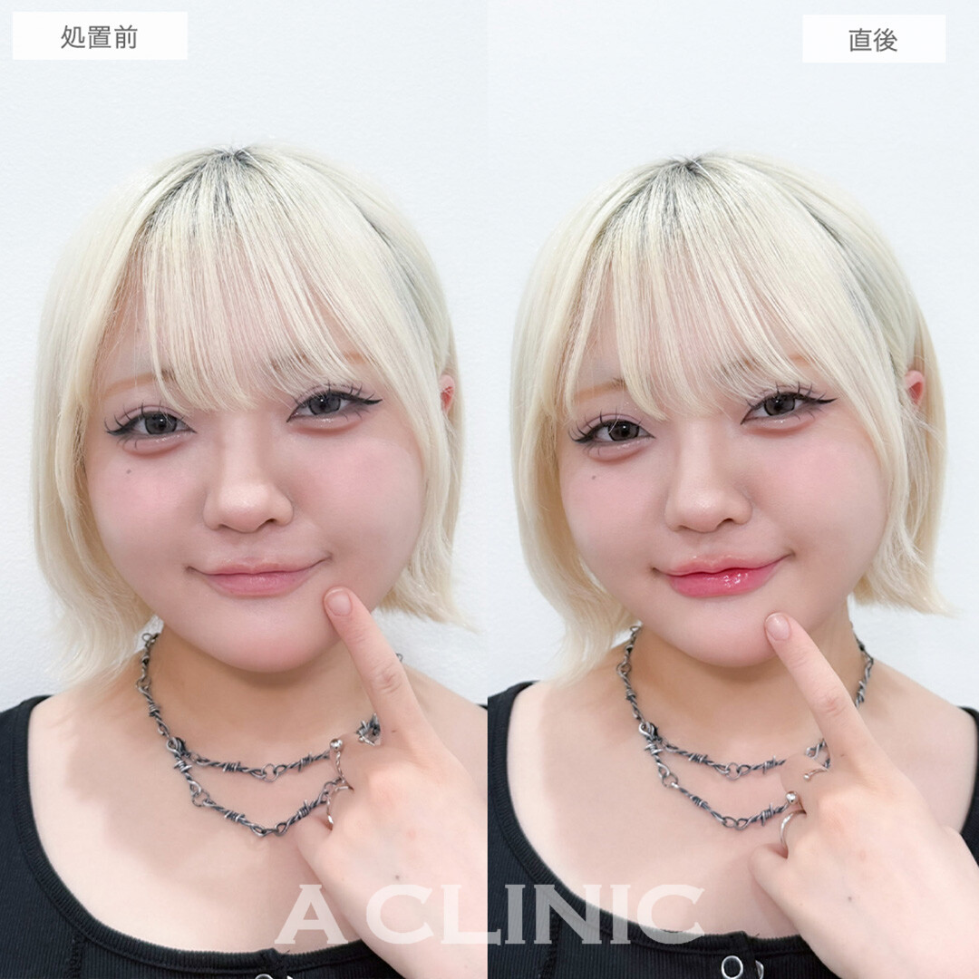 スマイルリップでバブみが増した可愛い口元に！処置前と直後の症例です(20代女性)