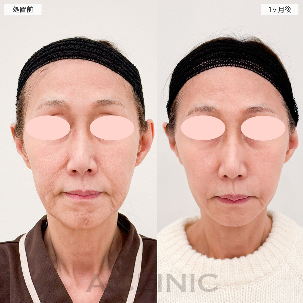 A式美肌たるみ切開で10歳以上若返りました！ こちら処置前から2ヶ月後の症例です(60代女性)
