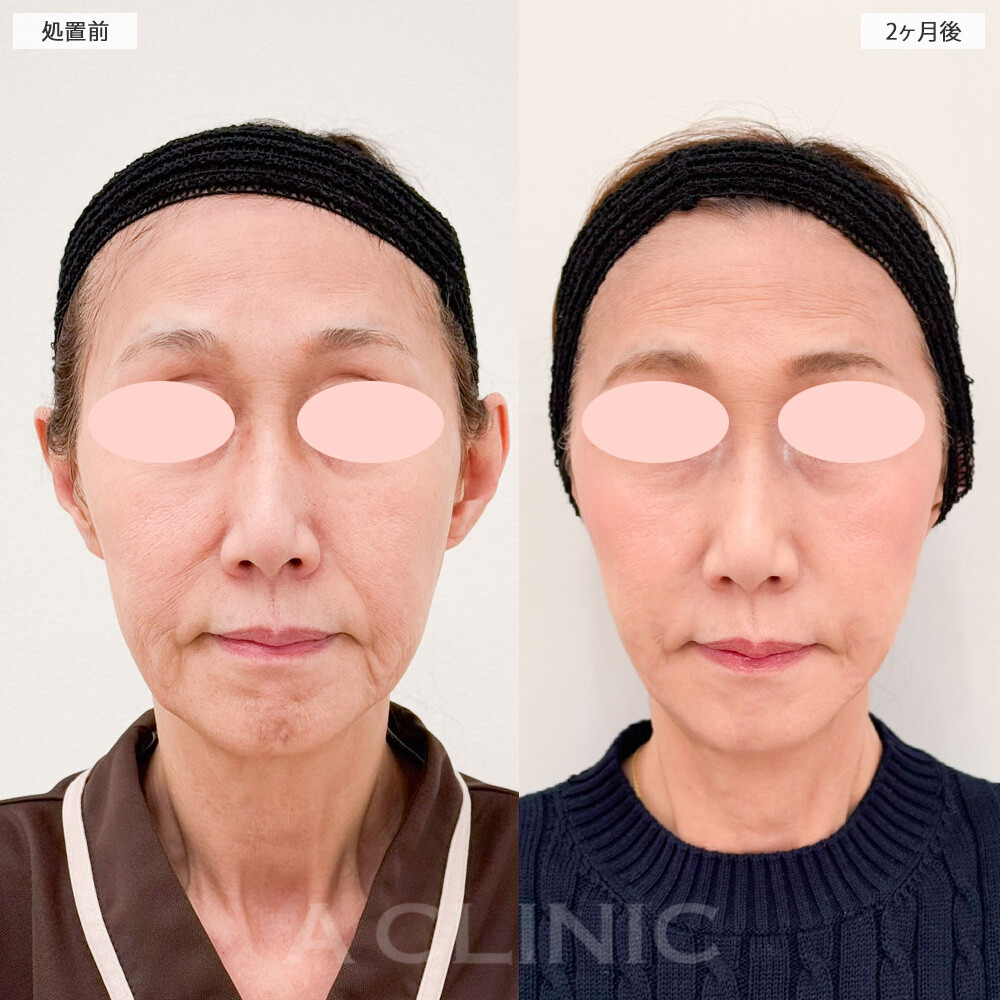 A式美肌たるみ切開で10歳以上若返りました！ こちら処置前から2ヶ月後の症例です(60代女性)