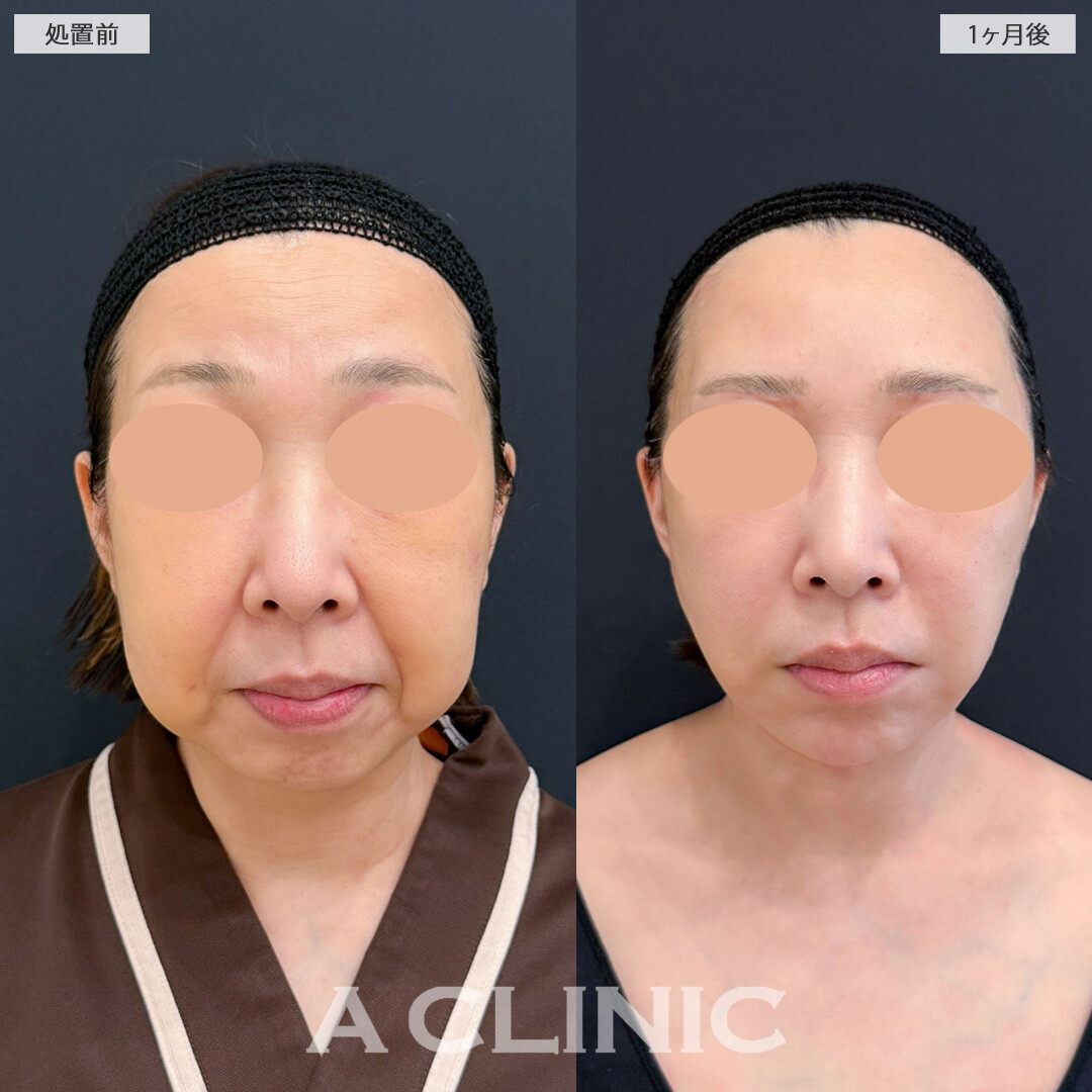 【直後の傷跡あり】A式美肌たるみ切開と1day小顔脂肪吸引で別人級の変化！こちら処置前と1ヶ月後の症例です(50代女性)