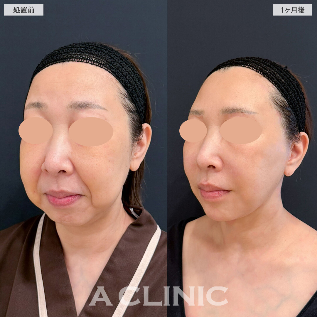 【直後の傷跡あり】A式美肌たるみ切開と1day小顔脂肪吸引で別人級の変化！こちら処置前と1ヶ月後の症例です(50代女性)