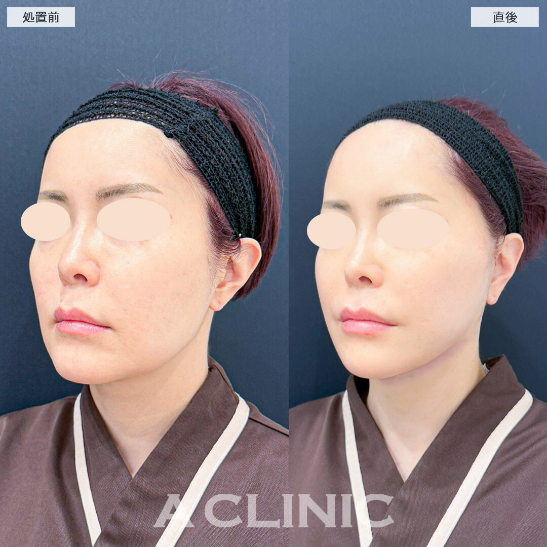 A式美肌たるみ切開でフェイスラインのたるみをしっかりリフトアップ！こちら処置前と直後の症例です(40代女性)