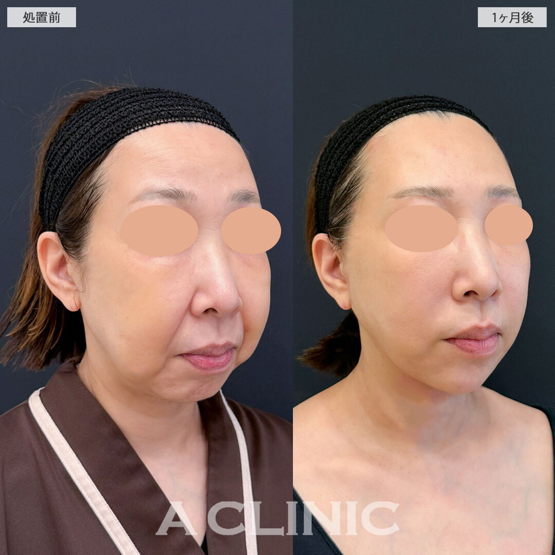 【直後の傷跡あり】A式美肌たるみ切開と1day小顔脂肪吸引で別人級の変化！こちら処置前と1ヶ月後の症例です(50代女性)