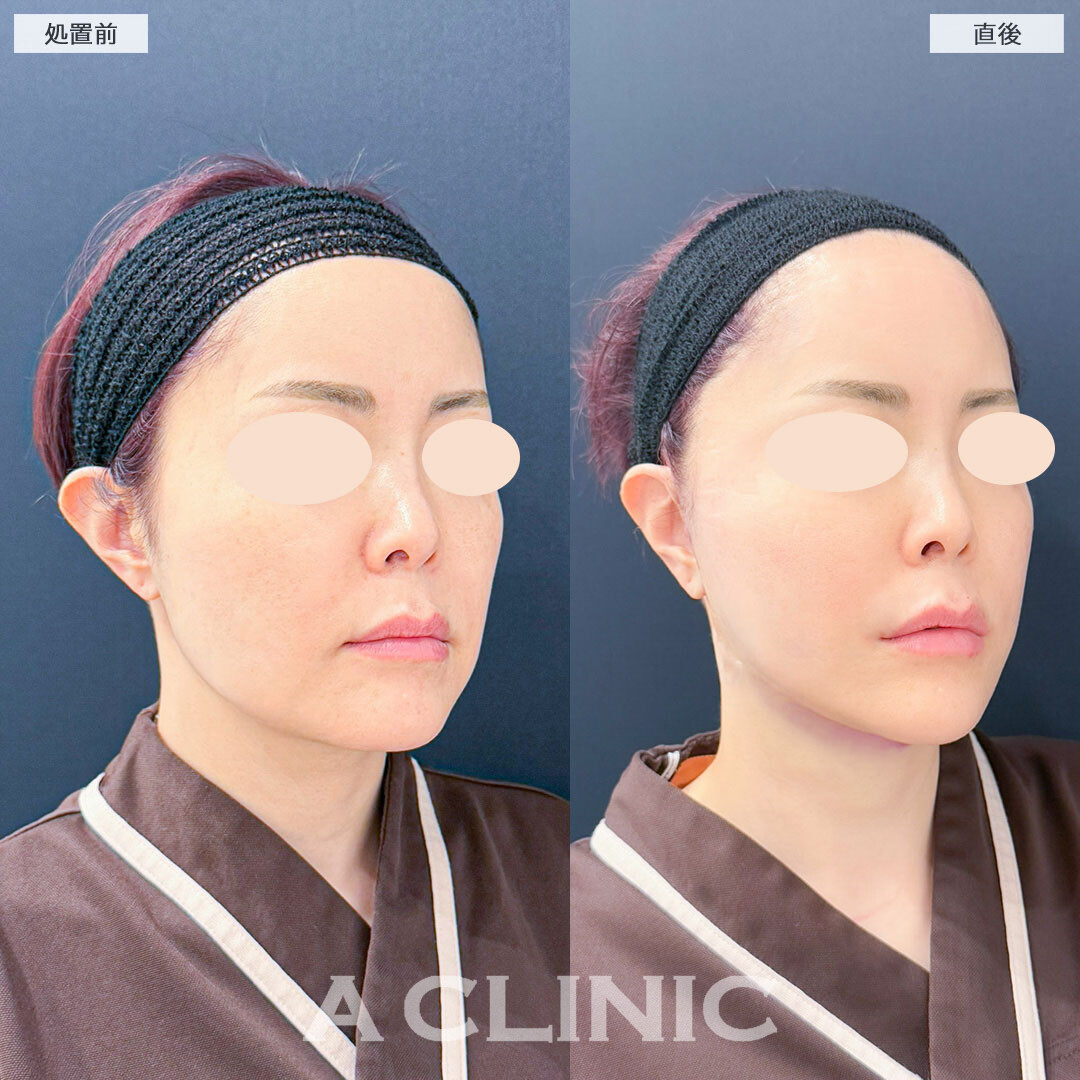 A式美肌たるみ切開でフェイスラインのたるみをしっかりリフトアップ！こちら処置前と直後の症例です(40代女性)