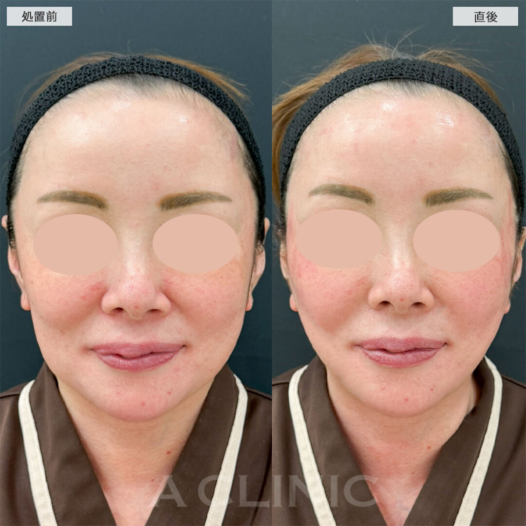 A式美肌たるみ切開で直後から強力リフトアップ！こちら処置前と直後と2週間後の症例です(40代女性)