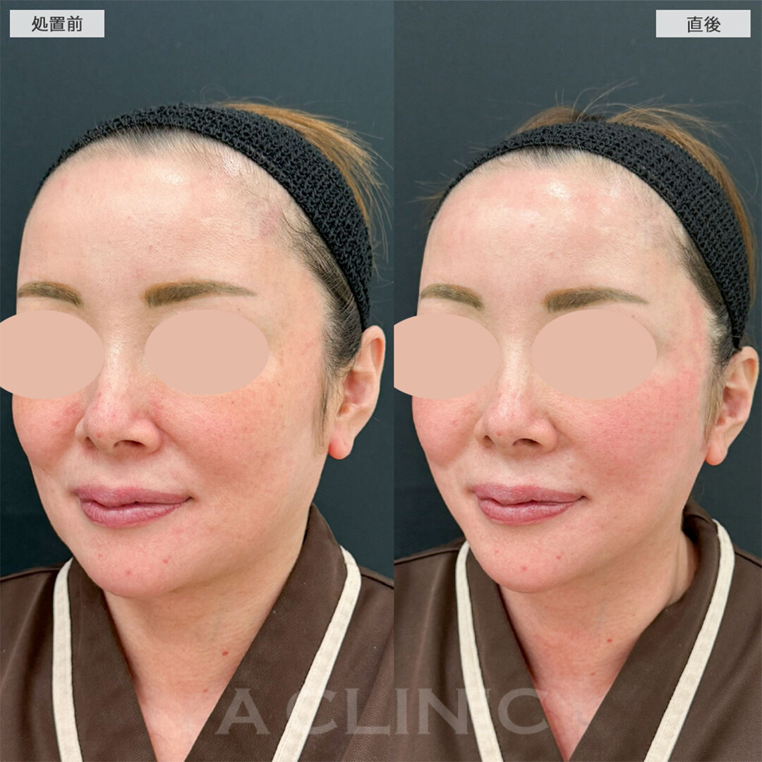 A式美肌たるみ切開で直後から強力リフトアップ！こちら処置前と直後と2週間後の症例です(40代女性)