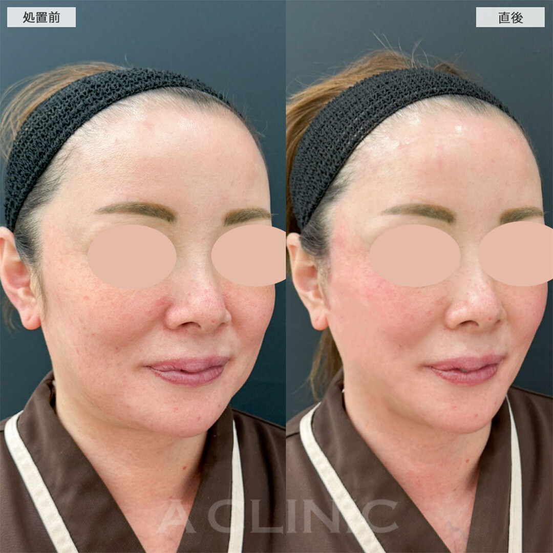 A式美肌たるみ切開で直後から強力リフトアップ！こちら処置前と直後と2週間後の症例です(40代女性)
