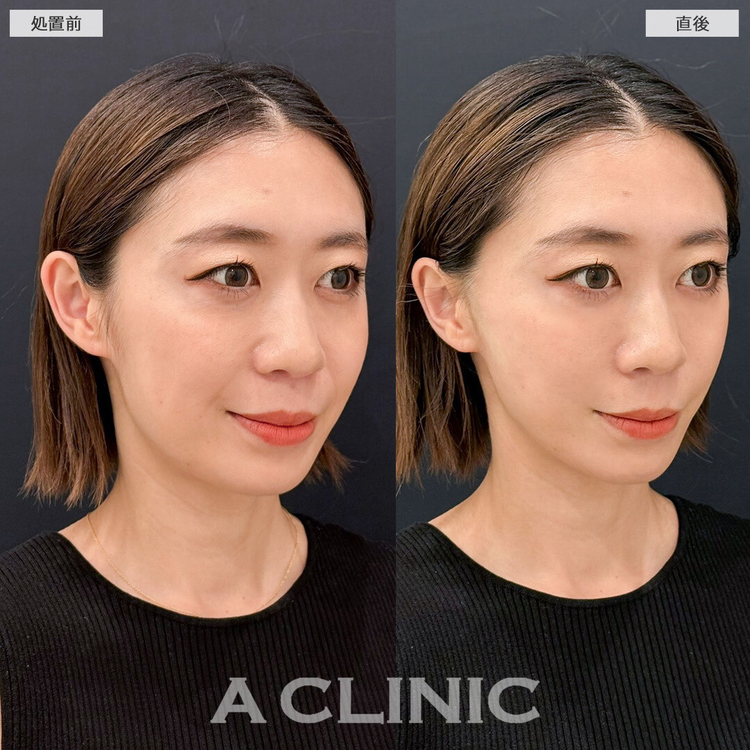Aスレッドでほうれい線が改善されました！こちら処置前と直後の症例です(30代女性)