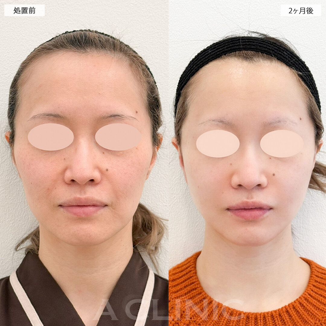 A式美肌たるみ切開で若返り成功！こちら処置前と2ヶ月後の症例です(40代女性)