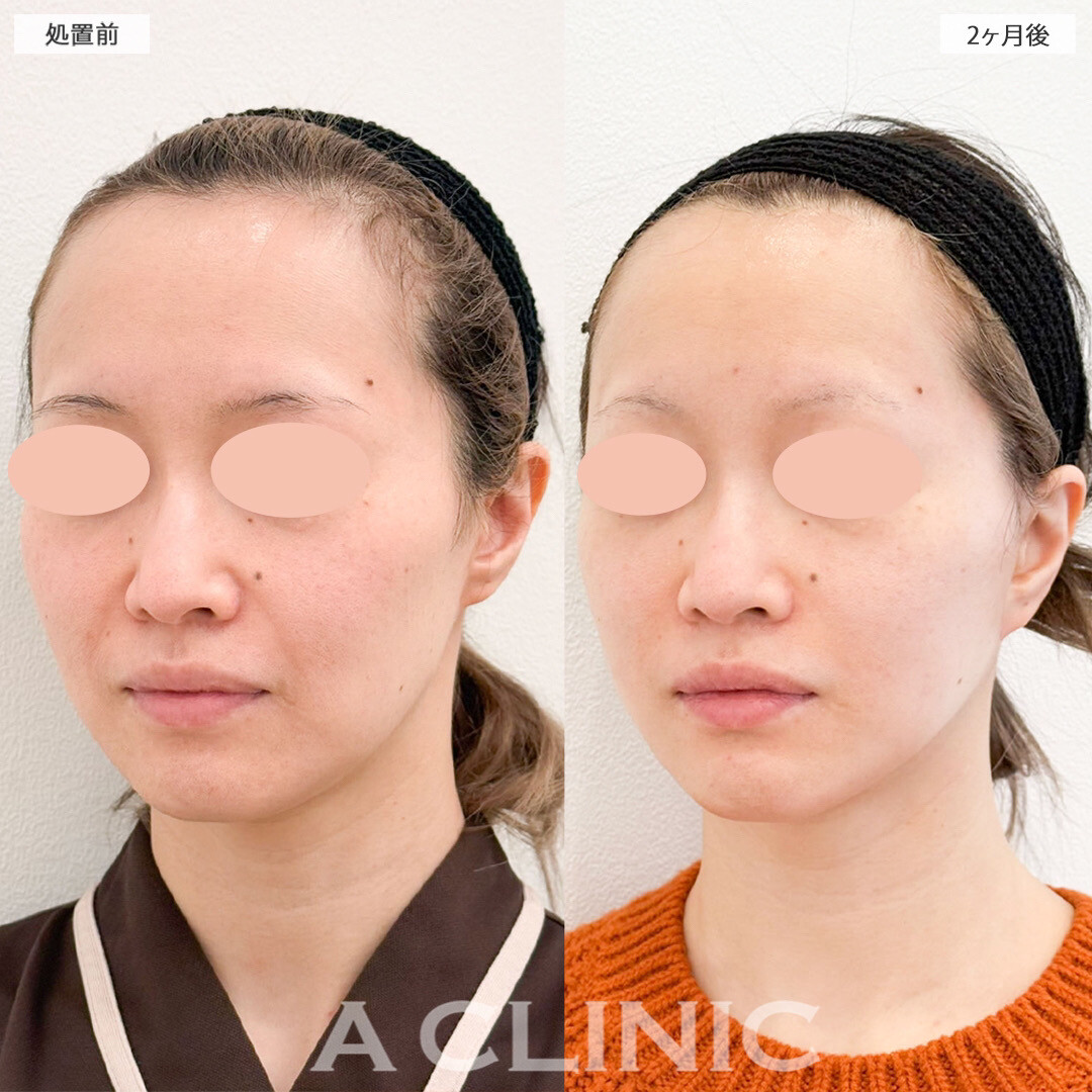 A式美肌たるみ切開で若返り成功！こちら処置前と2ヶ月後の症例です(40代女性)