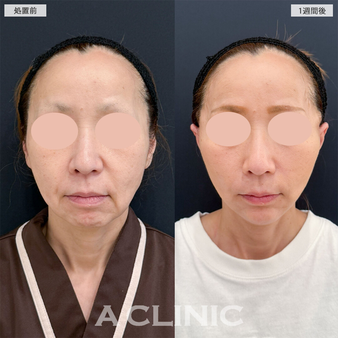 A式美肌たるみ切開で余分な皮膚が無くなり引き締まった輪郭に！こちら処置前と1週間後の症例です(50代女性)