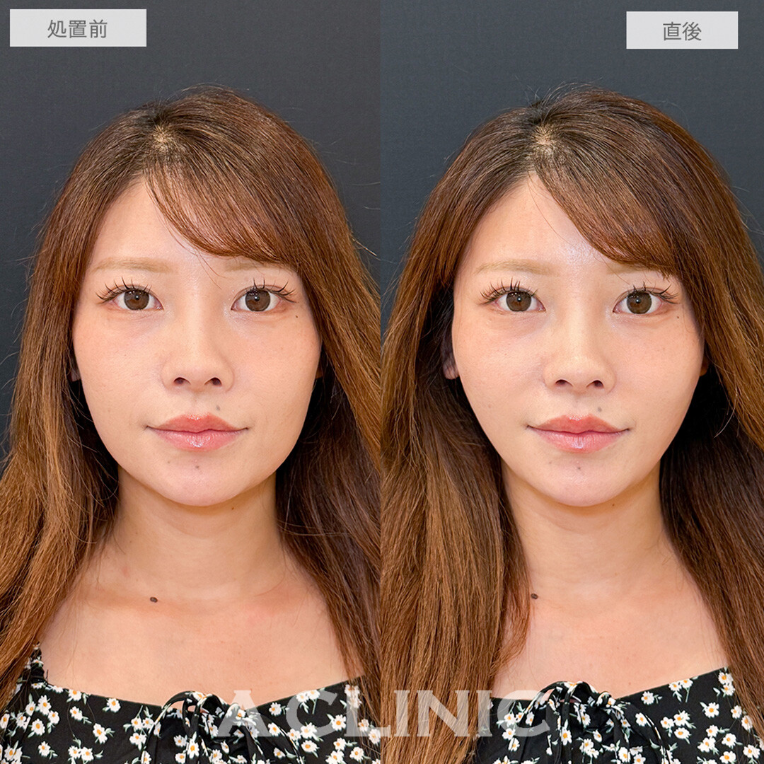 Aスレッドで直後から一回り小顔に！こちら処置前と直後の症例です(30代女性)