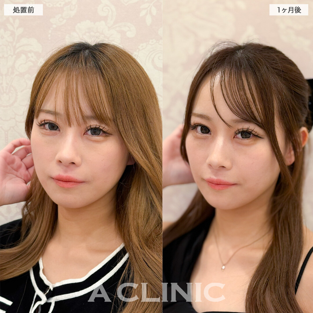 1day小顔脂肪吸引とあごへのヒアルロン酸注入を組み合わせて余白減らして小顔アップデート！こちら処置前と1ヶ月後の症例です(20代女性)