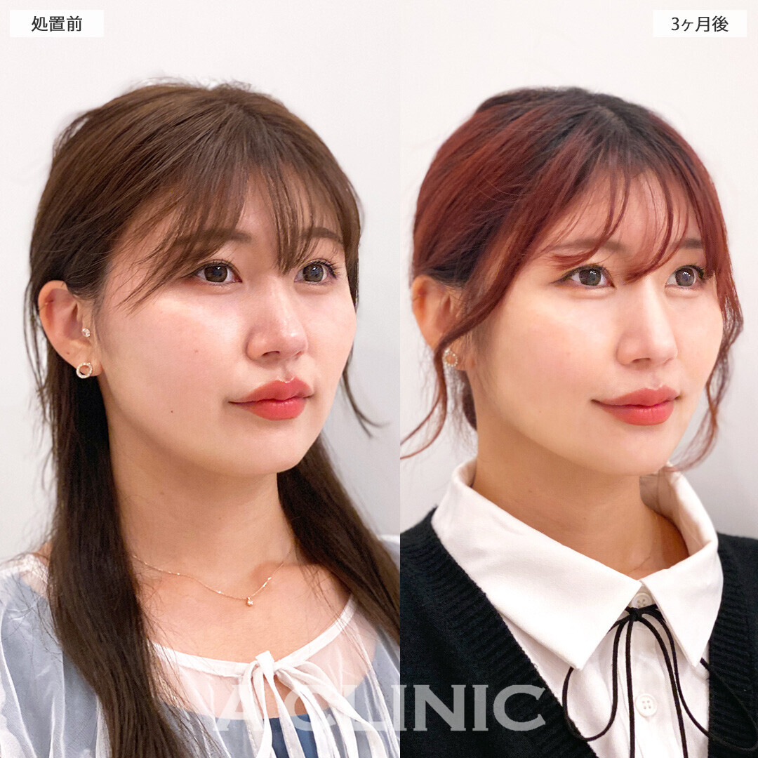 1day小顔脂肪吸引で脂肪が減りスッキリした印象になりました！処置前と3ヶ月後の症例です(30代女性)
