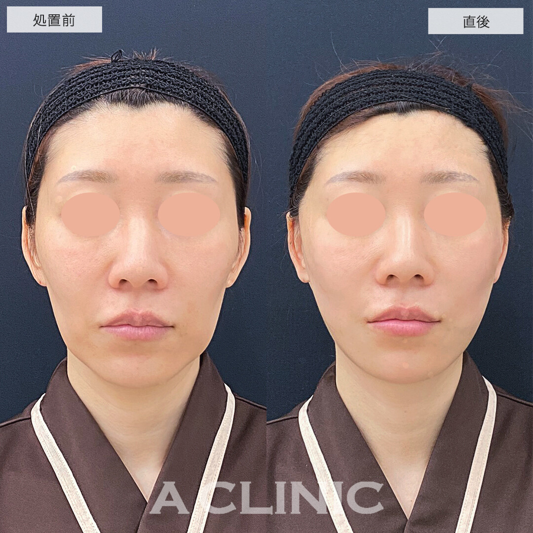 A式美肌たるみ切開と1day小顔脂肪吸引で下にたるんだ輪郭をキュッと上向きに！処置前と直後の症例です(40代女性)