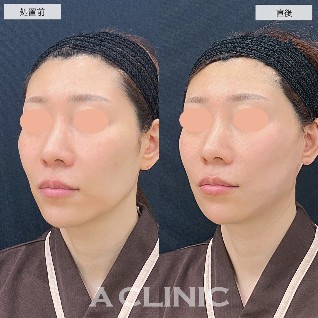 A式美肌たるみ切開と1day小顔脂肪吸引で下にたるんだ輪郭をキュッと上向きに！処置前と直後の症例です(40代女性)