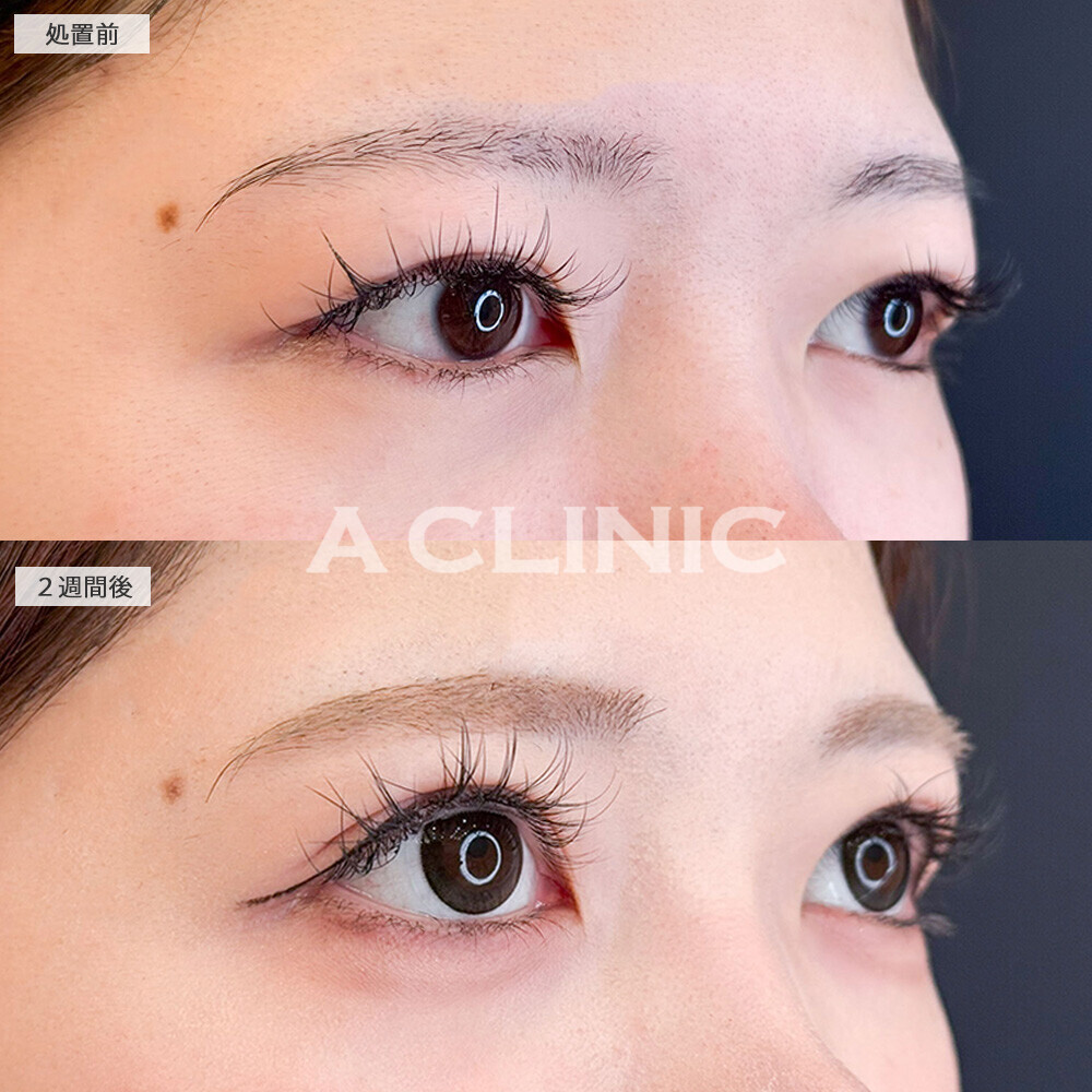 二重術埋没法で目の開きがよくなり縦幅アップしました！こちら処置前と2週間後の症例です(20代女性)