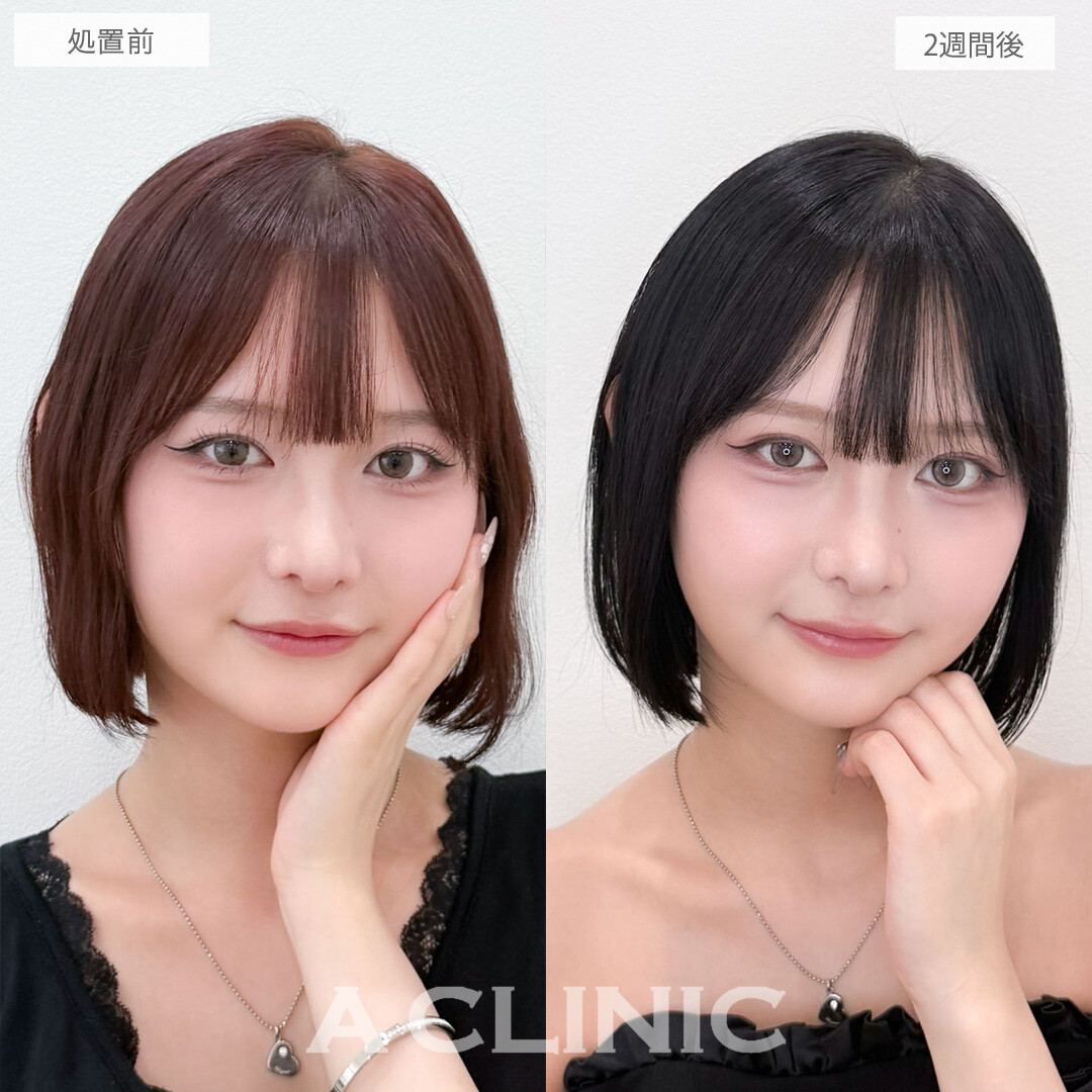 二重術埋没法で左右差が無くなりさらに印象的な目元に！こちら処置前と2週間後の症例です(20代女性)