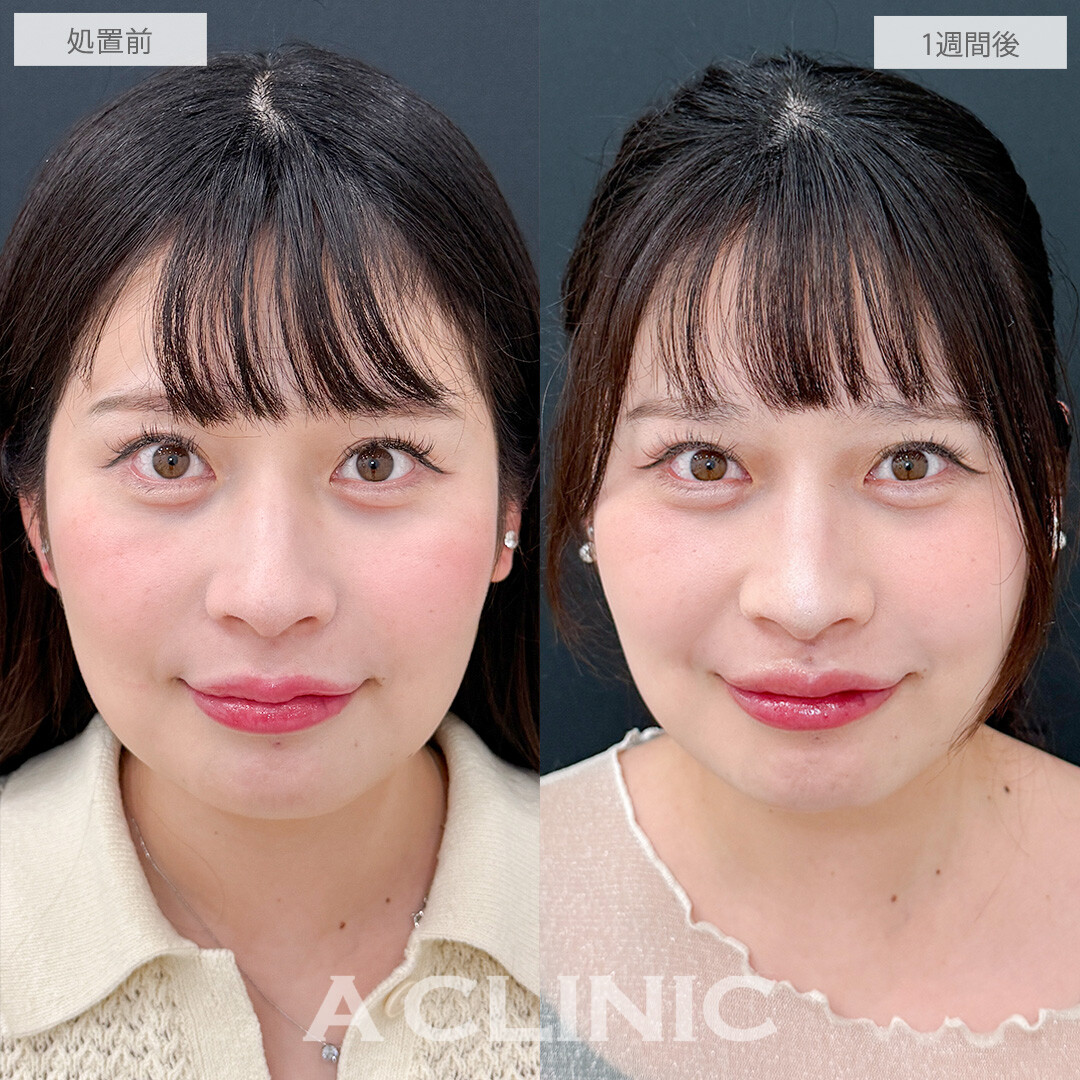 切らない人中短縮(Cカール形成術)なら腫れ等のダウンタイムが最小限！こちら処置前と1週間後の症例です(30代女性)