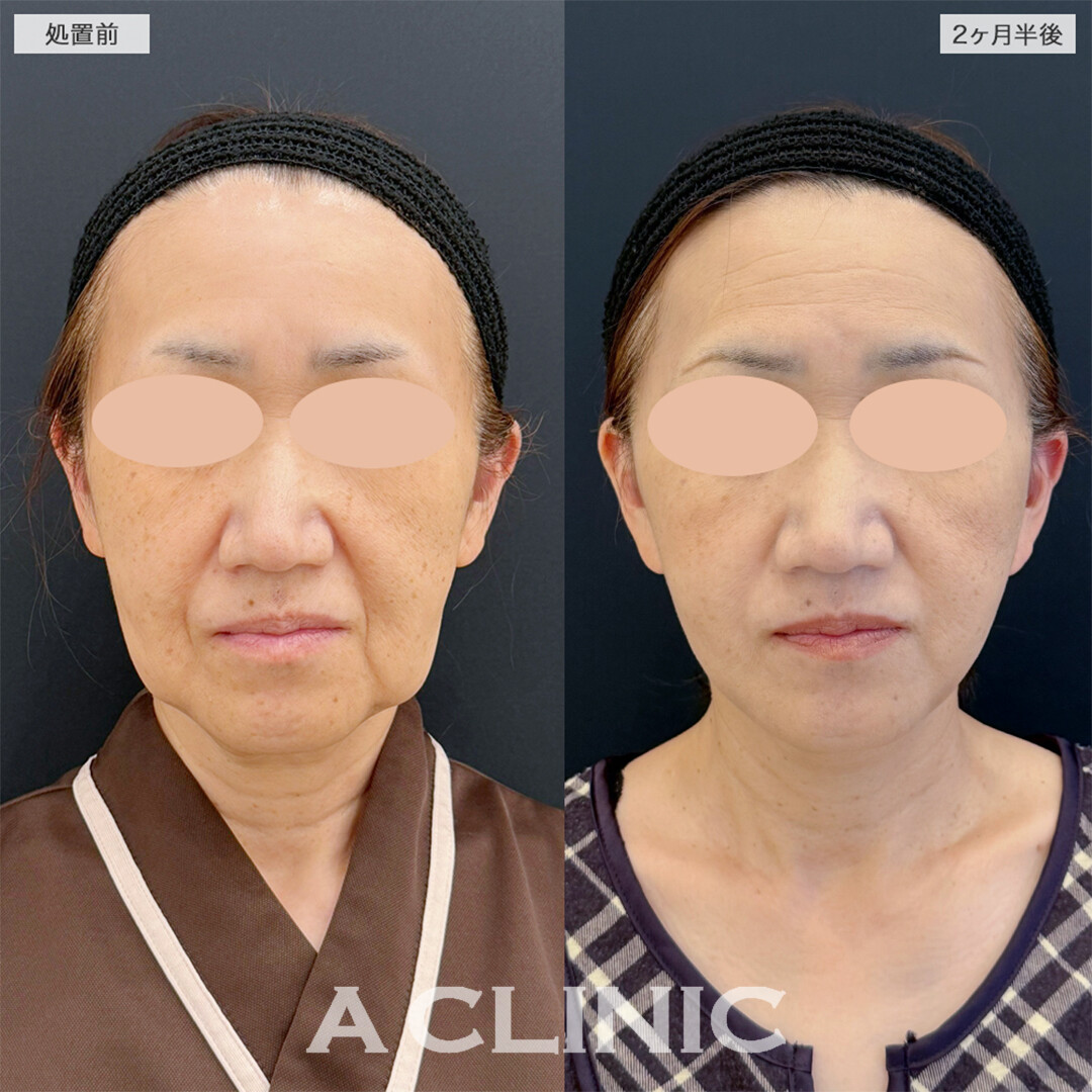 A式美肌たるみ切開で綺麗な卵型フェイスに！こちら処置前と2ヶ月半後の症例です(50代女性)