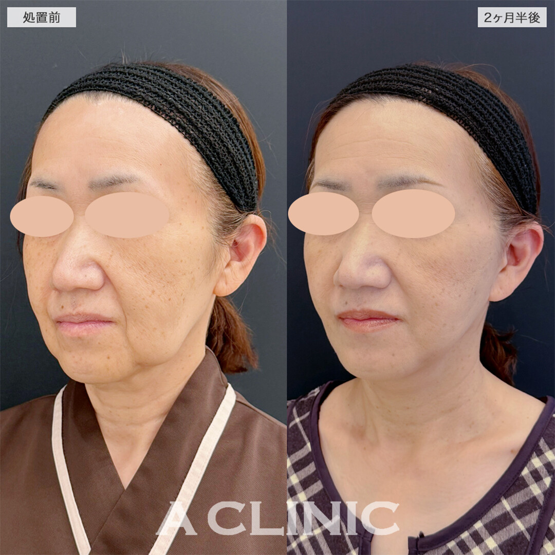 A式美肌たるみ切開で綺麗な卵型フェイスに！こちら処置前と2ヶ月半後の症例です(50代女性)