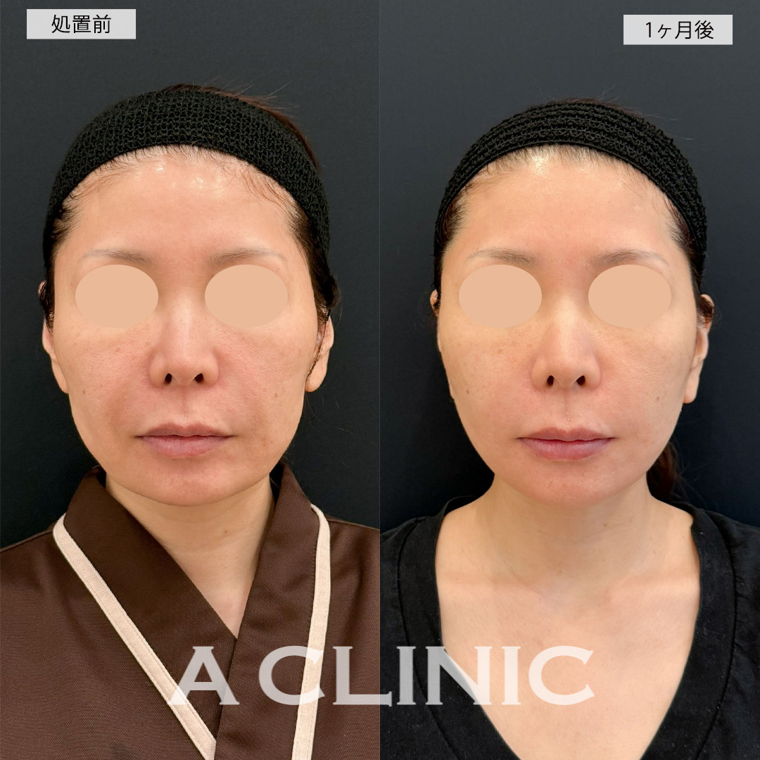 A式美肌たるみ切開でほうれい線のシワが緩和され若返り！こちら処置前と1ヶ月後の症例です(40代女性)