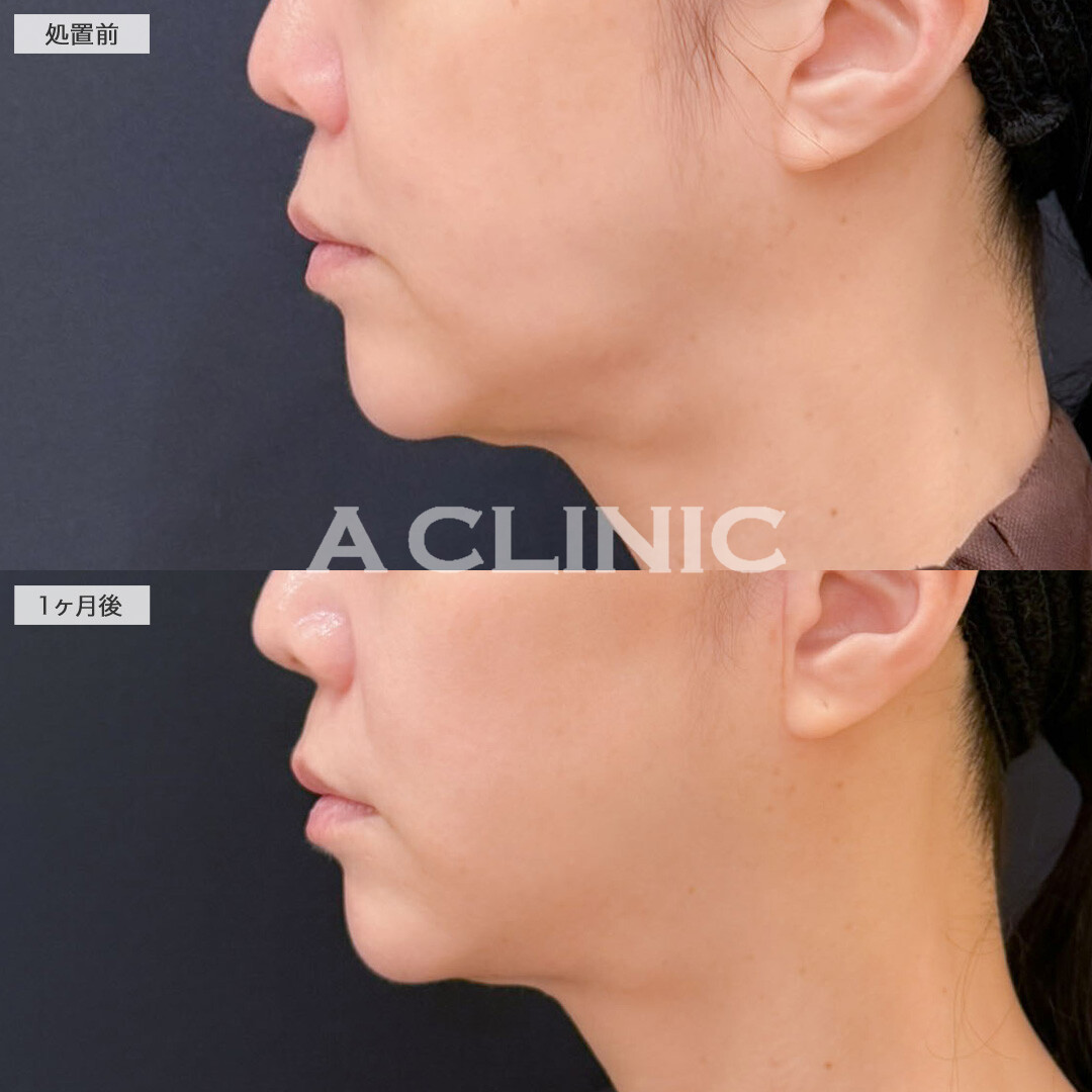 ナゾラビアルファット除去術とA式美肌たるみ切開でほうれい線を薄くすることができました！こちら処置前と1ヶ月後の症例です(40代女性)